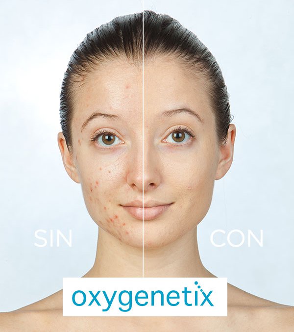 Oxygenetix - Medicina Estética Alarcón | Tratamientos Láser Madrid Clínica
